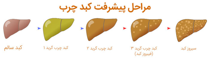 کبد چرب گرید 2